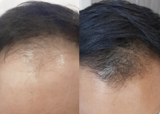 With 3 Months of Indiba Treatments