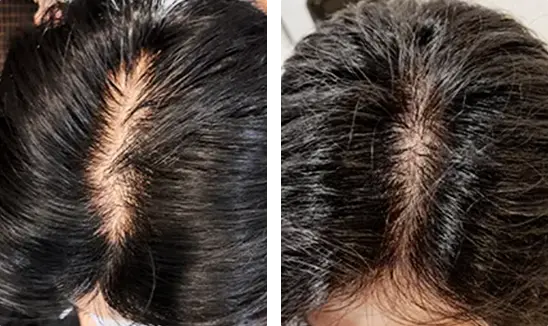 Tried and tested svenson's success storied, male 33, with 3 months of treatment