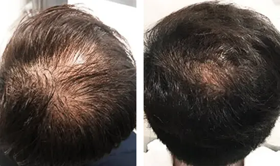 Tried and tested svenson's success storied, male 44, with 6 months of treatment