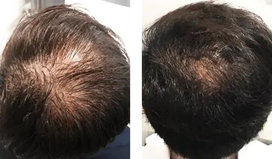 Tried and tested svenson's success storied, male 48, with 6 months of treatment
