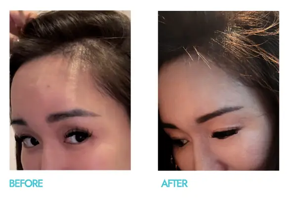 Tried and tested svenson's success storied, male 32, with 3 months of treatment